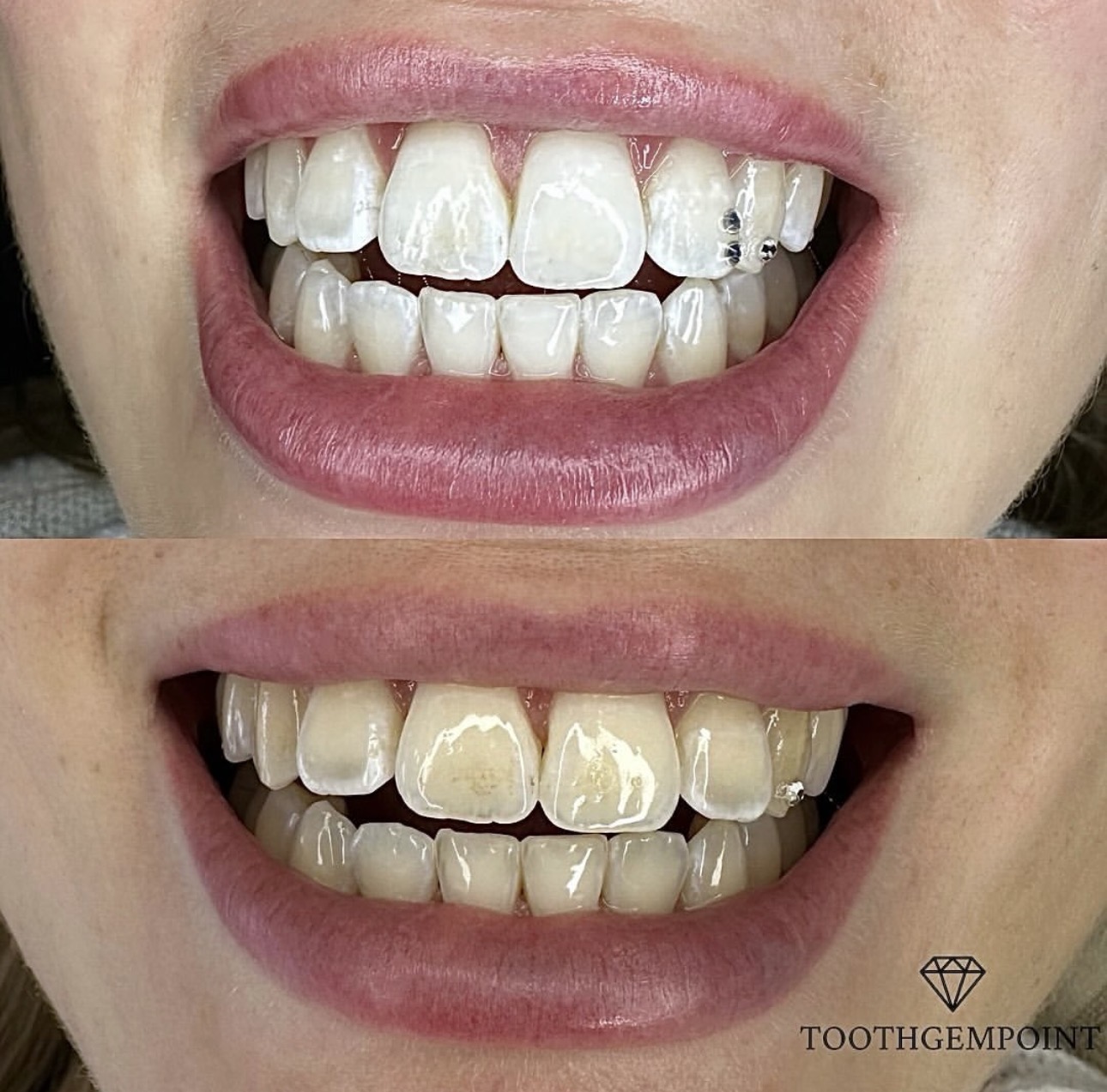 Tanden bleken resultaat 1