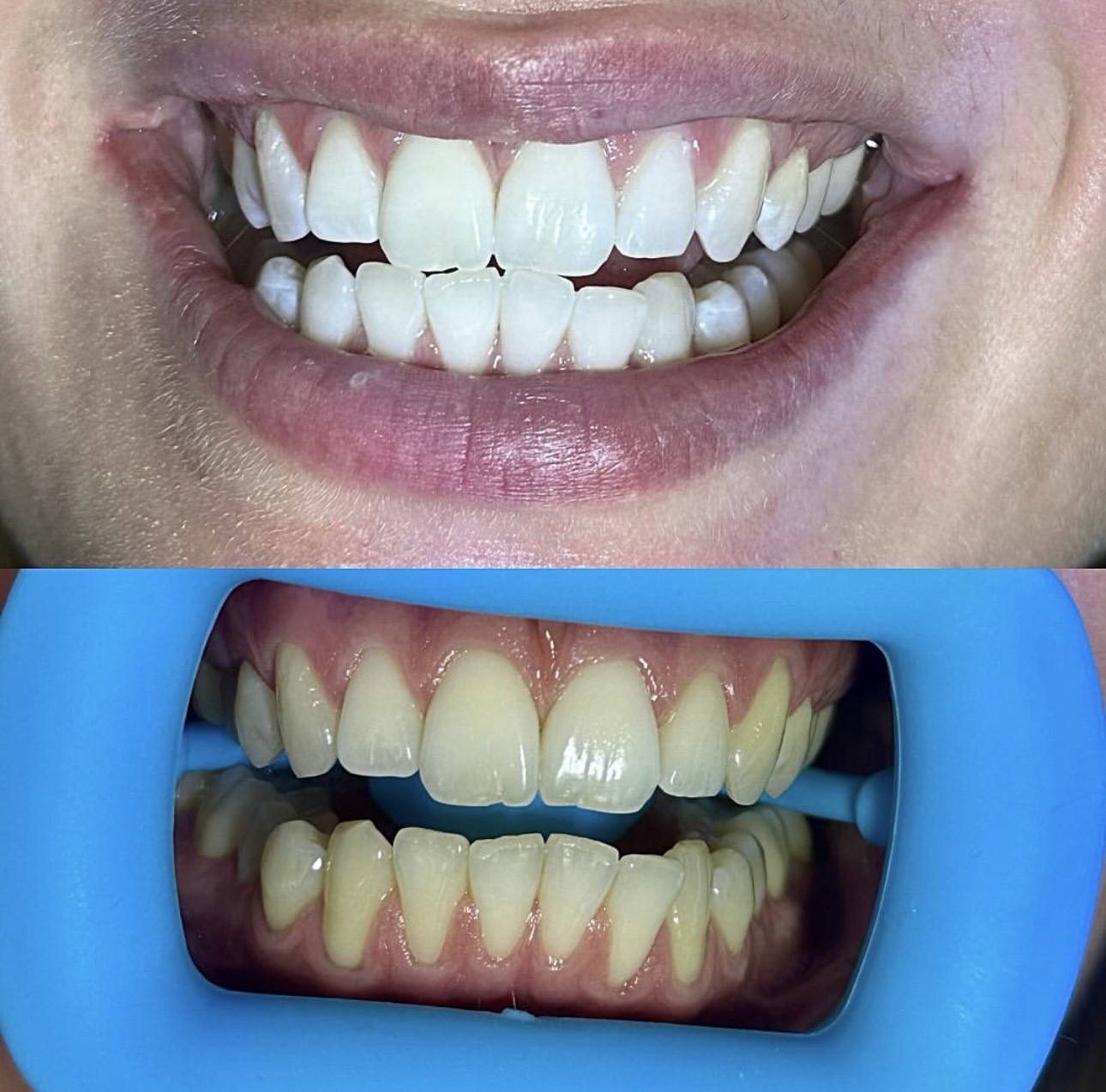 Tanden bleken resultaat 2