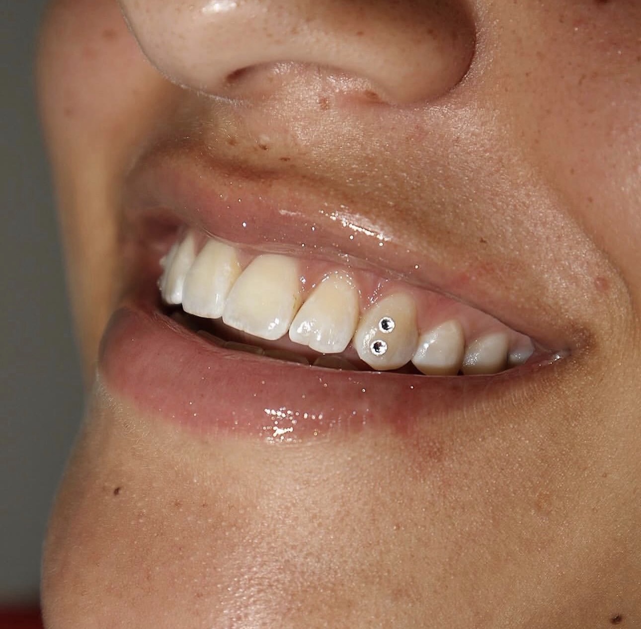 Toothgems resultaat 2