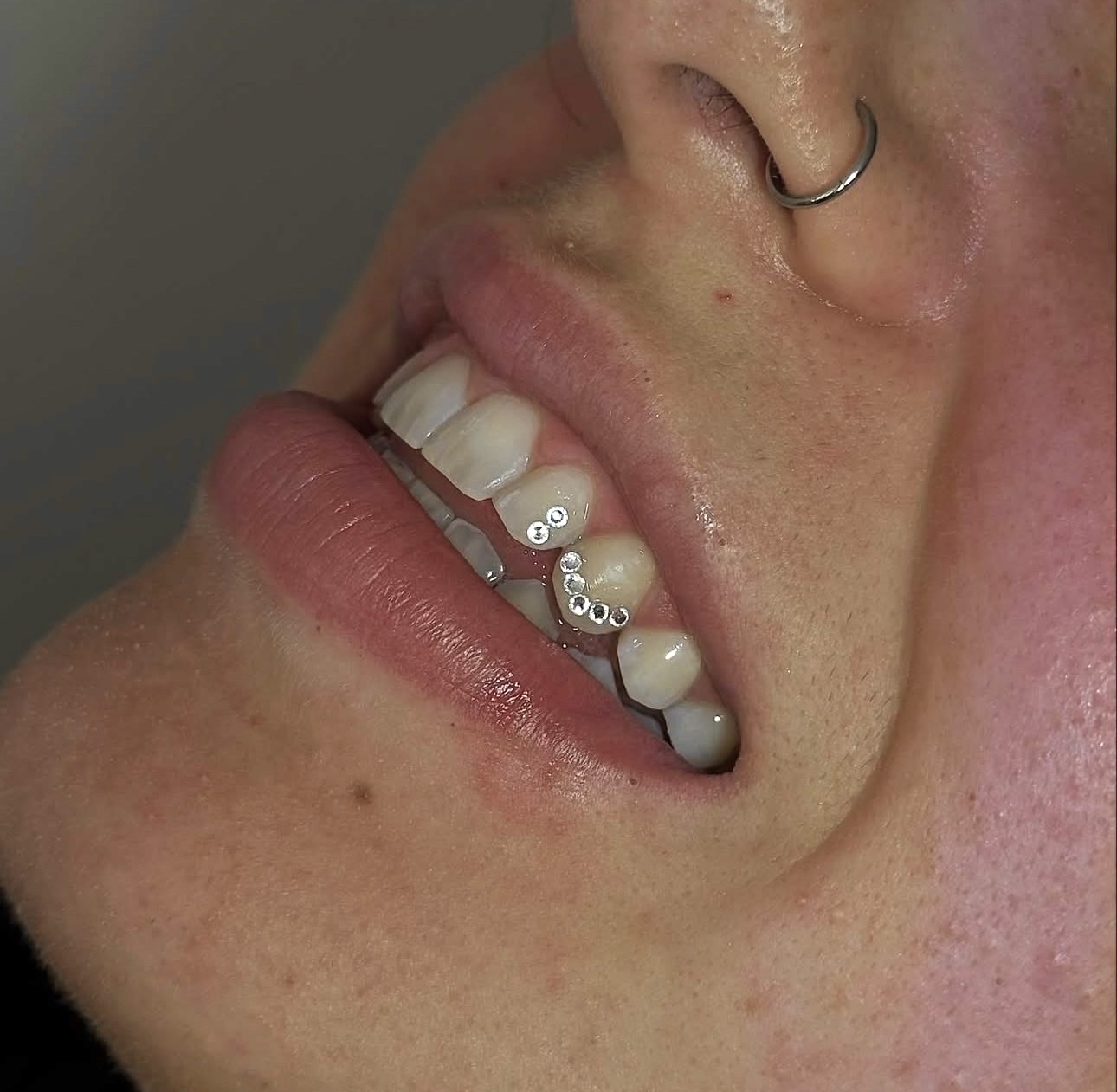 Toothgems resultaat 3